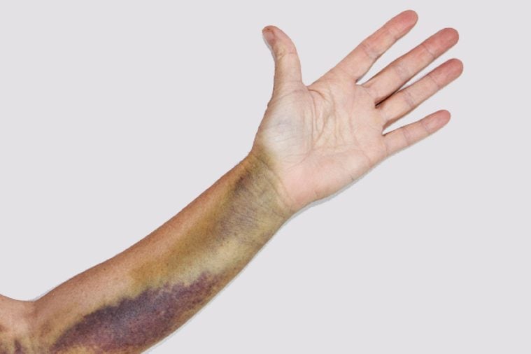 Intense bruising from a dislocated elbow joint, break of the olecranon bone and ligament damage on a mature woman. The bruise is approximately three weeks old and starting to recede.