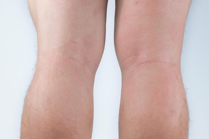 Allergic rash dermatitis eczema skin on leg of patient. Psoriasis and eczema skin with big red spots.