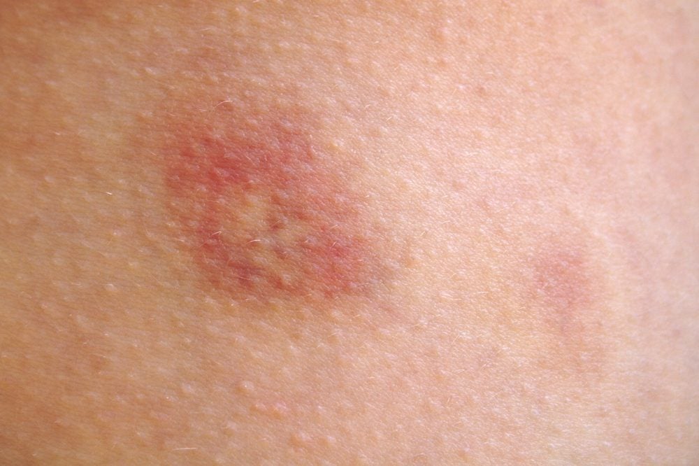 single flat red spots on skin itchy