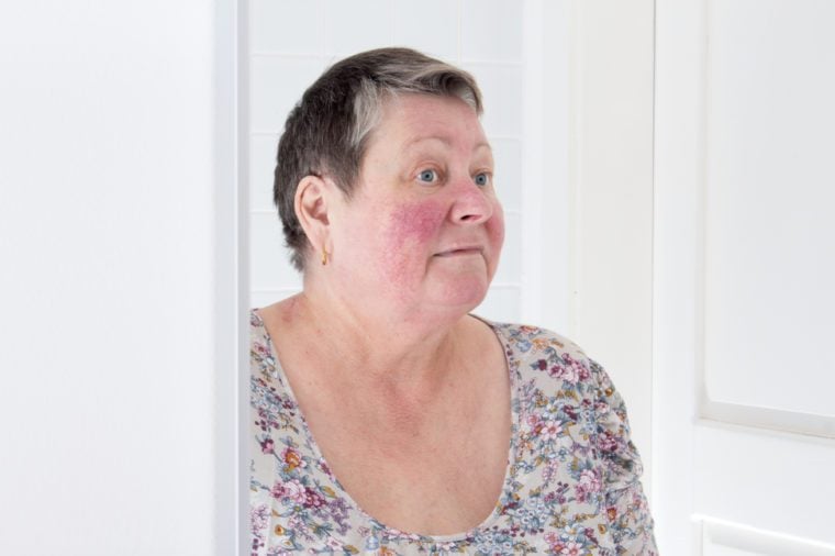 Unhappy elderly woman with skin condition rosacea characterized by facial redness, small and superficial dilated blood vessels, no make-up