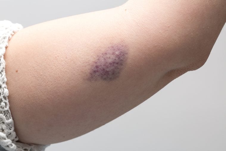 Woman bruise