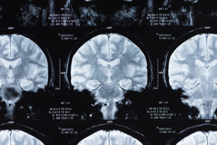 magnetinio rezonanso vaizdas, smegenų MR nuskaitymas.