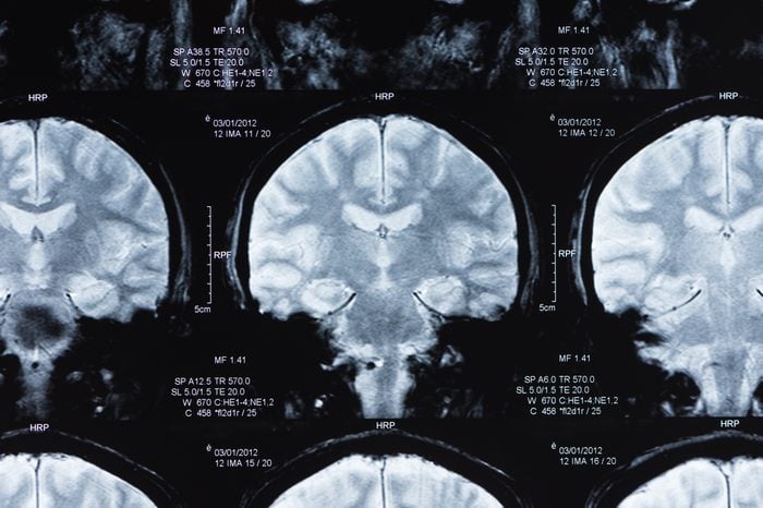 magnetic resonance image, mri scan of the brain.