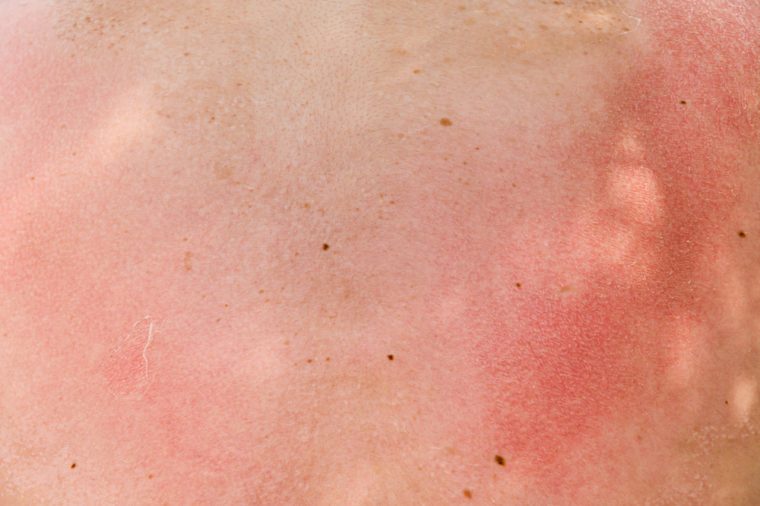 burnt skin sunburn a great extent, the sun, many small blisters closeup