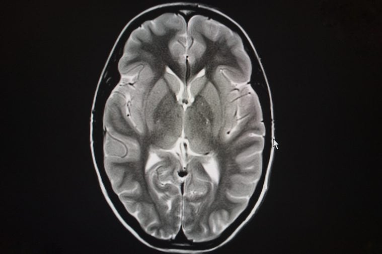 axial T2 magnetic resonance of the brain 