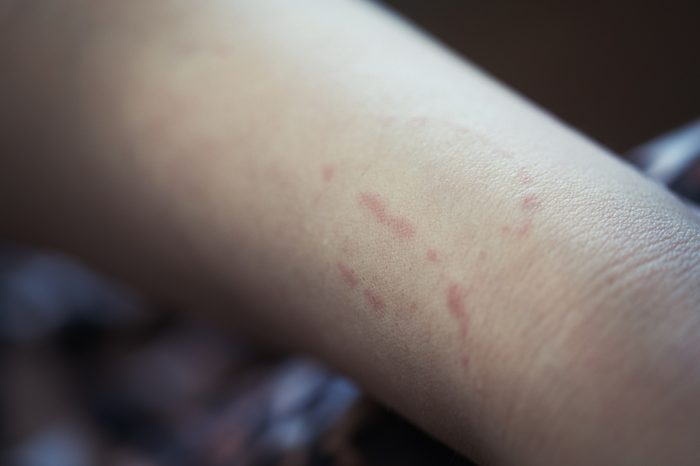 Toddler's bite marks on mothers arm - aggressive toddlers behavior psychology