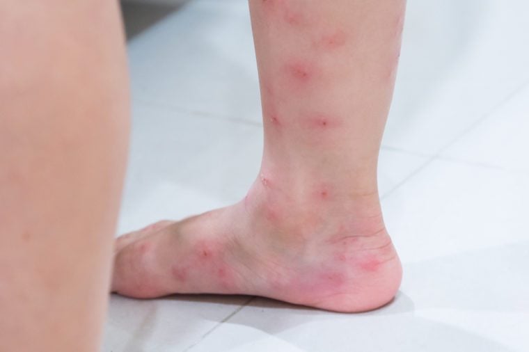 Red blisters on a girl's legs after ants bite (Solenopsis geminata ,tropical fire ant ).