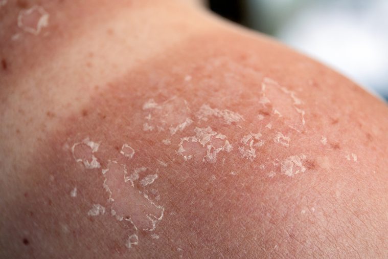 Peeling skin at back and shoulder from sunburn effect. Holidays and relaxation, abstract summer season background