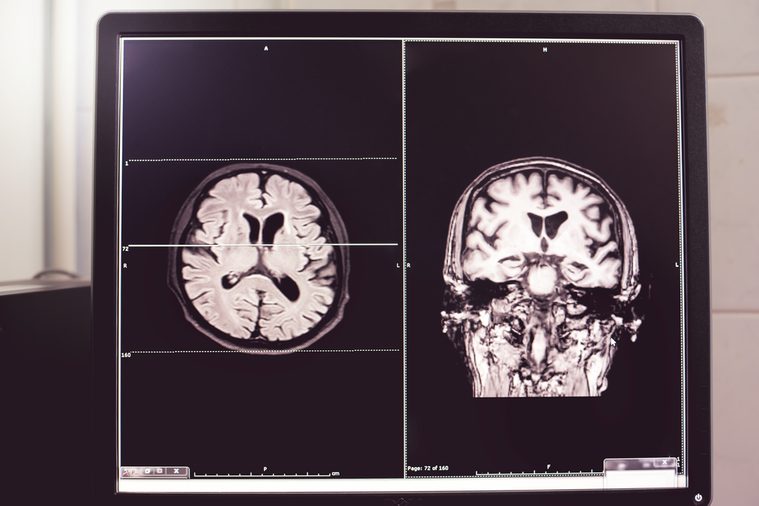 MRI brain of Dementia patientHippocampal atrophy grade 4 by MTA scaleTemporal atrophy