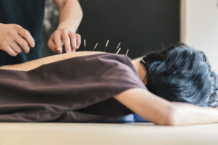 Therapist Giving acupuncture Treatment To a Japanese Woman