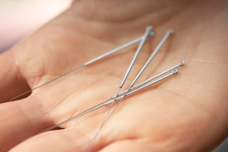 Female hand with needles for acupuncture, closeup