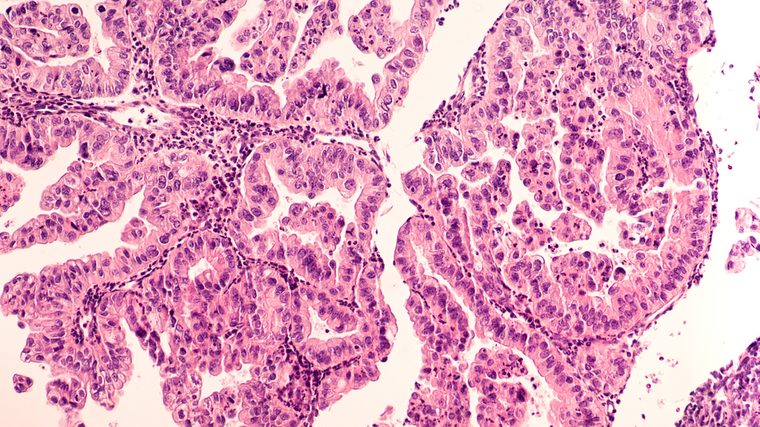 Ovarian Cancer Awareness: Micrograph of a serous papillary carcinoma (adenocarcinoma) of ovary, with intricately branching papillae. This tumor has a poor prognosis, as early detection is problematic.