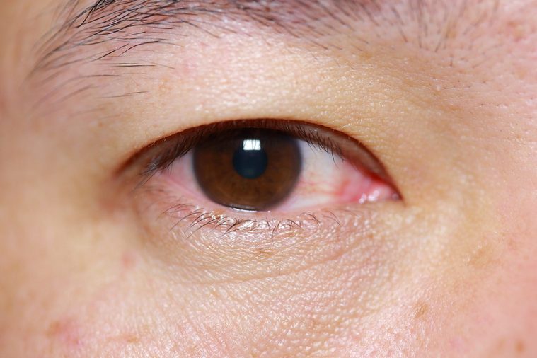 close up of mark injected viral conjunctivitis during eye examination, eye or after cry.