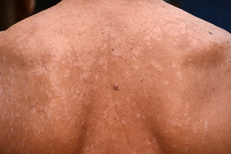 Tinea versicolor/Pityriasis versicolor on the skin