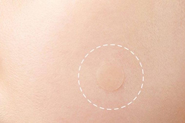 Circle on the skin indicating targeted acne treatment.