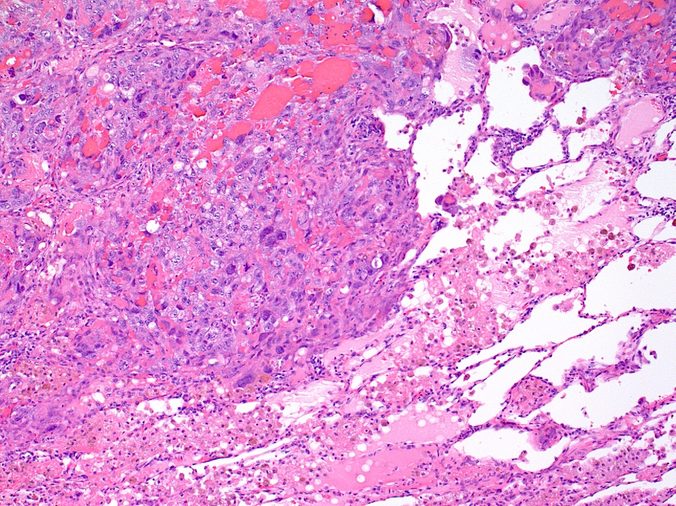 Squamous cell carcinoma of lung (left half of image) replacing normal healthy lung tissue (right side) with many tumor cell undergoing mitotic cell division