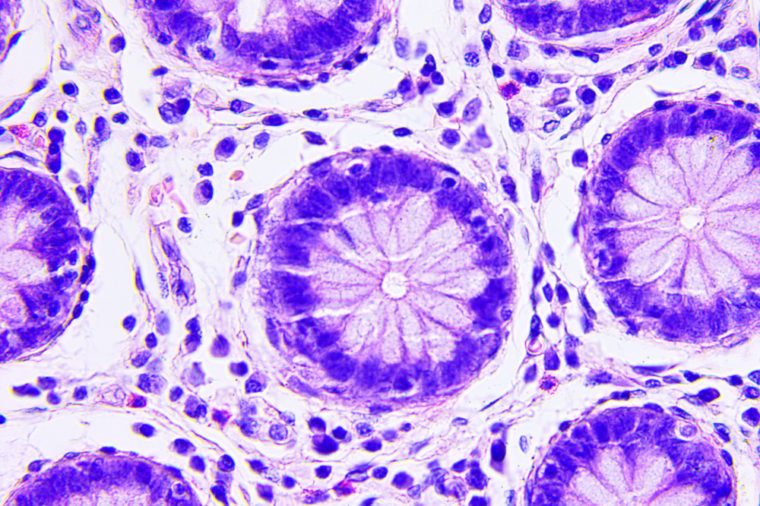 Colon cancer microscopic photograph