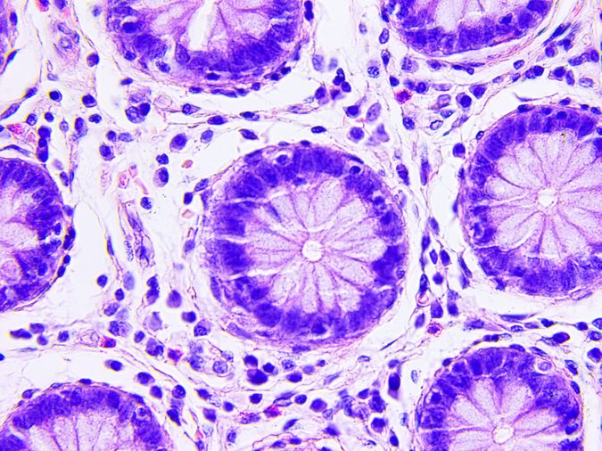 Colon cancer microscopic photograph