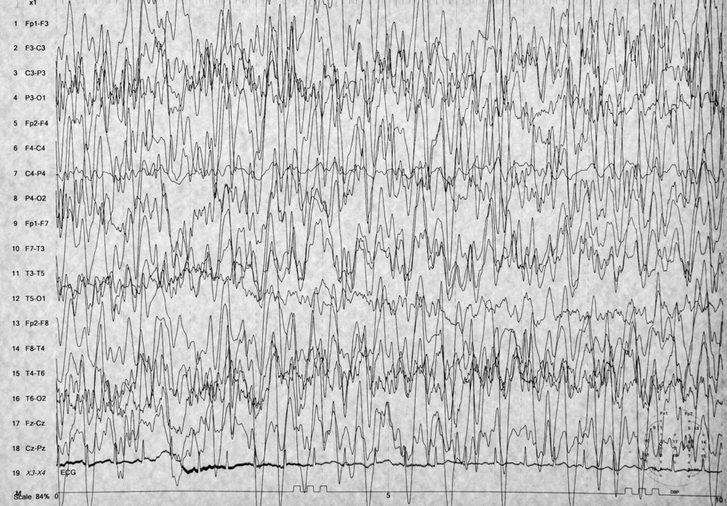 EEG brain wave on white background,Abnormal human brain wave,Seizure or Epilepsy on EEG background
