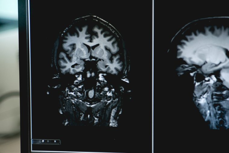 Dementia MRI brain for study alzheimer's disease