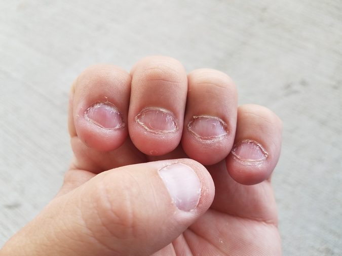 disgusting bitten fingernails on man's hand