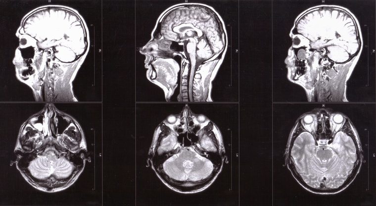 Magnetic resonance imaging of human head, tomography