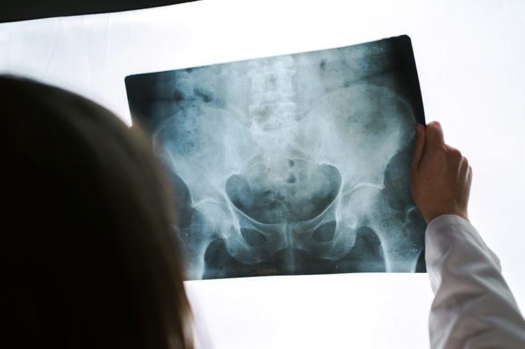 Female doctor examining pelvis x-ray in hospital office, medical professional in white uniform analyzing hip image in clinic
