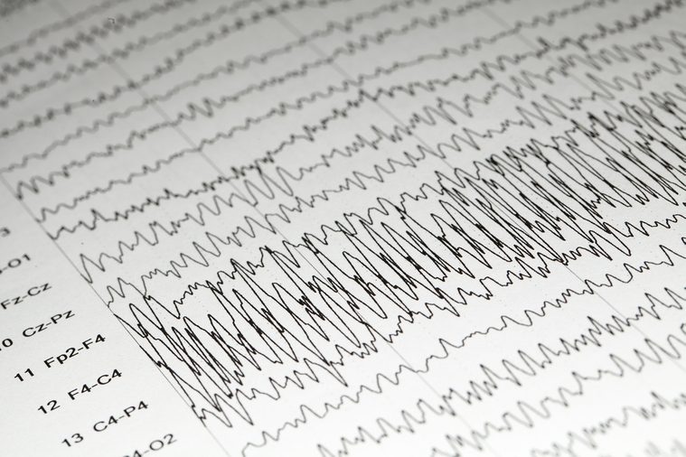 Abnormal EEG on brain wave background,Epileptiform discharge