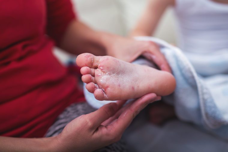 Boy with symptoms hand, foot and mouth disease