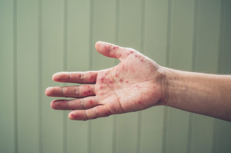 A young man is showing his hand with spots and rash from hand foot and mouth disease