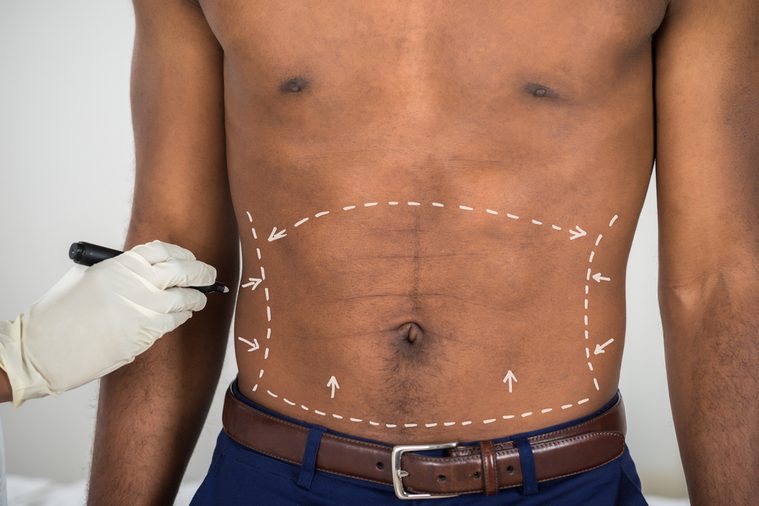 Close-up Of Person's Hand Drawing Correction Lines On Abdomen Of African Man