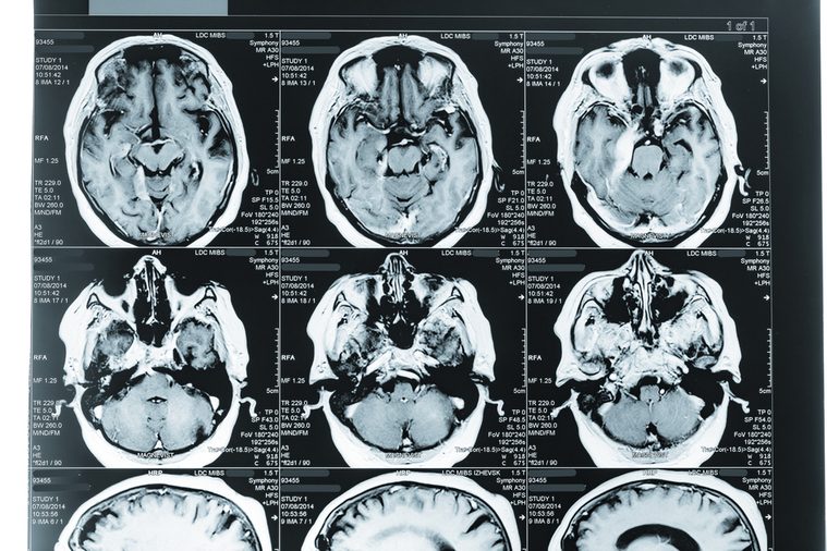 MRI Head Scan. Blue toned Image