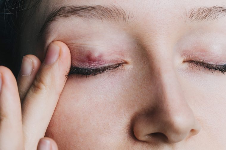 young girl shows a chalazion on the eyelid closeup