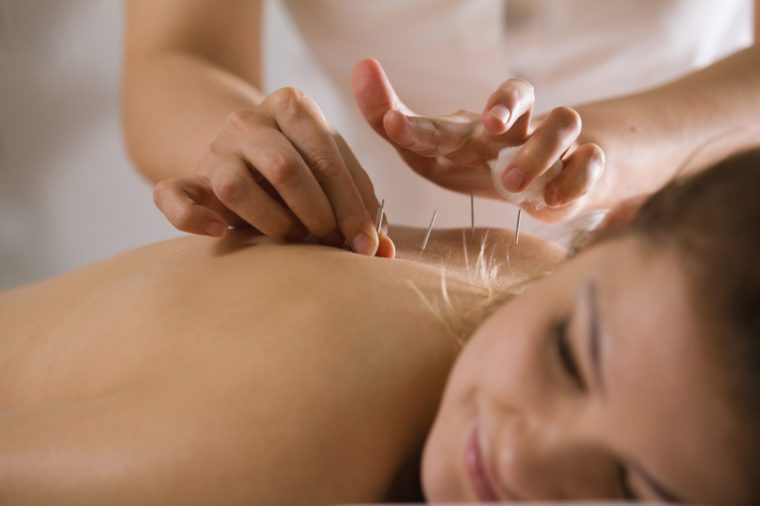 The doctor sticks needles into the woman's body on the acupuncture - close up