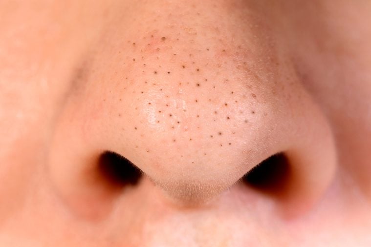 Close up of blackhead pimples on the nose