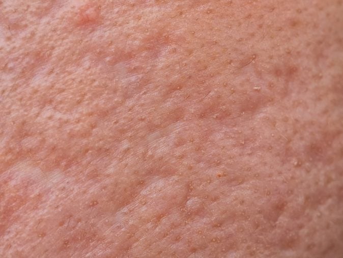 close up of nodular cystic acne skin