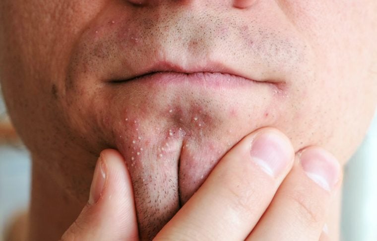Man's hands squeeze whiteheads on the chin