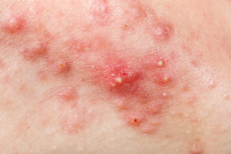 Close up photo of nodular cystic acne skin