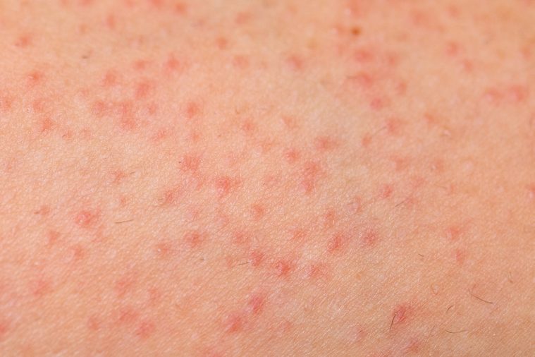 Close up picture of papules on skin