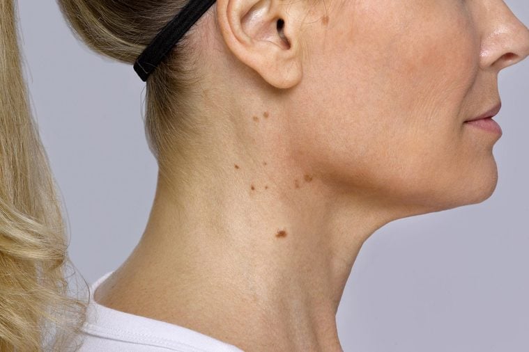 A woman's neck with acanthosis nigricans spots.