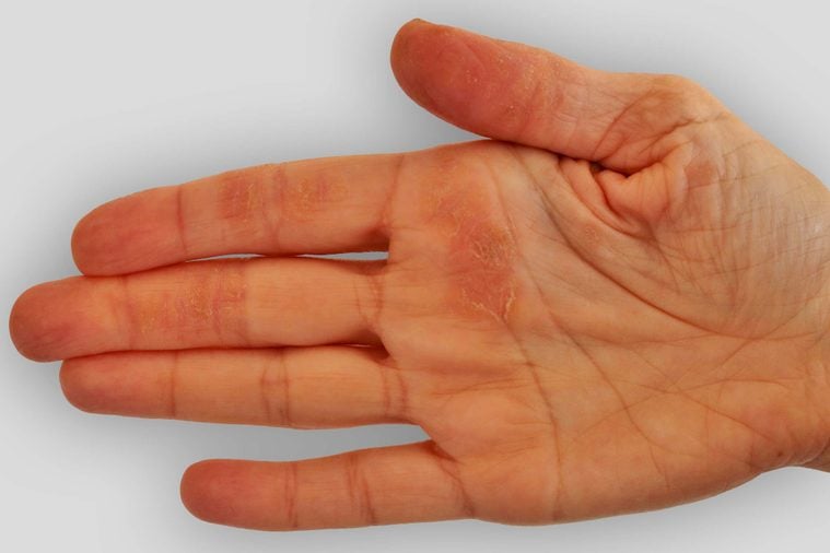 hand with blotchy red spot