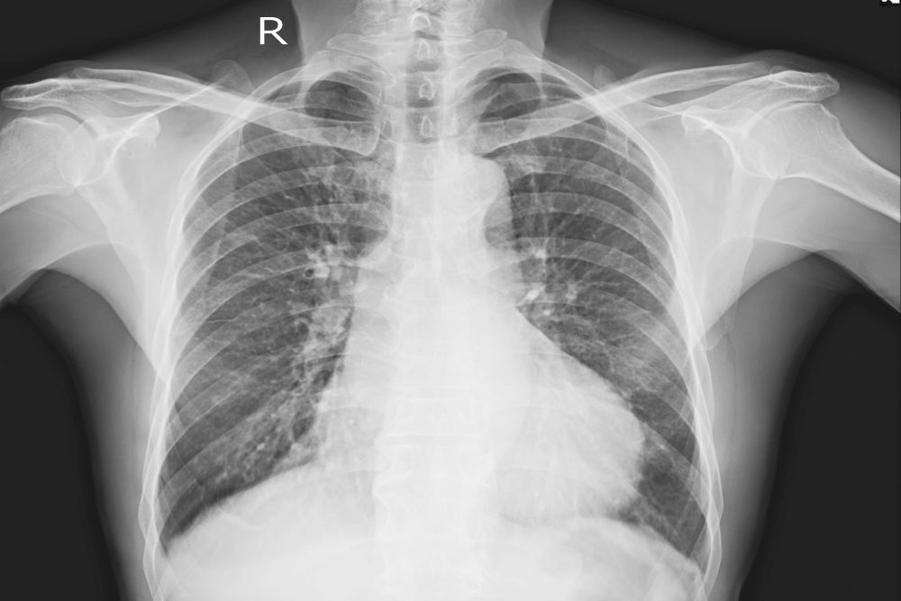 X-ray Chest Upright A Male 76 year old Fine Cardiomegaly.No definite active lung infiltration or lung mass.No pleural effusion.