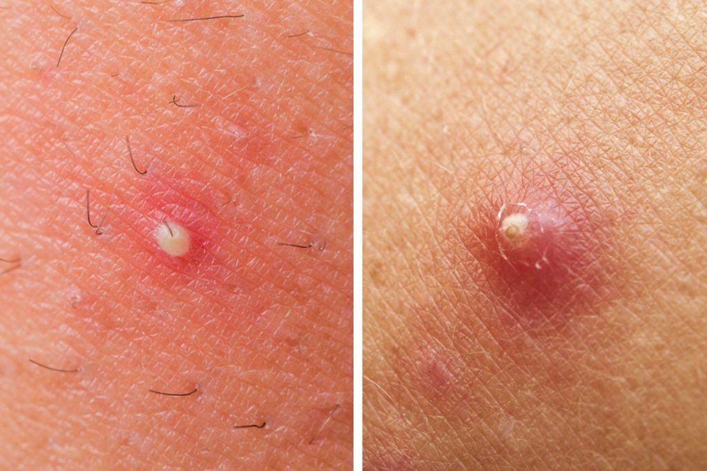 The Difference Between a Pimple and a Boil | Reader's Digest