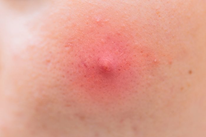 Closeup Big Acne Head skin Inflammation problem