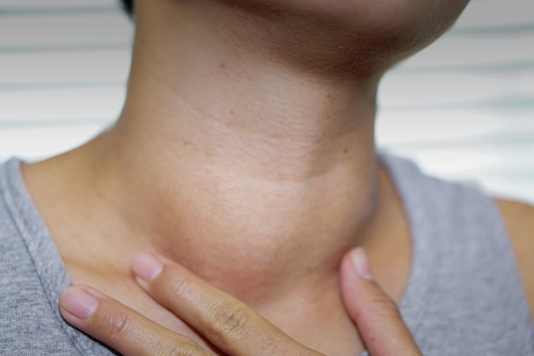 Asian lady woman patient have abnormal enlargement of thyroid gland Hyperthyroidism (overactive thyroid) at the throat : healthy strong medical concept