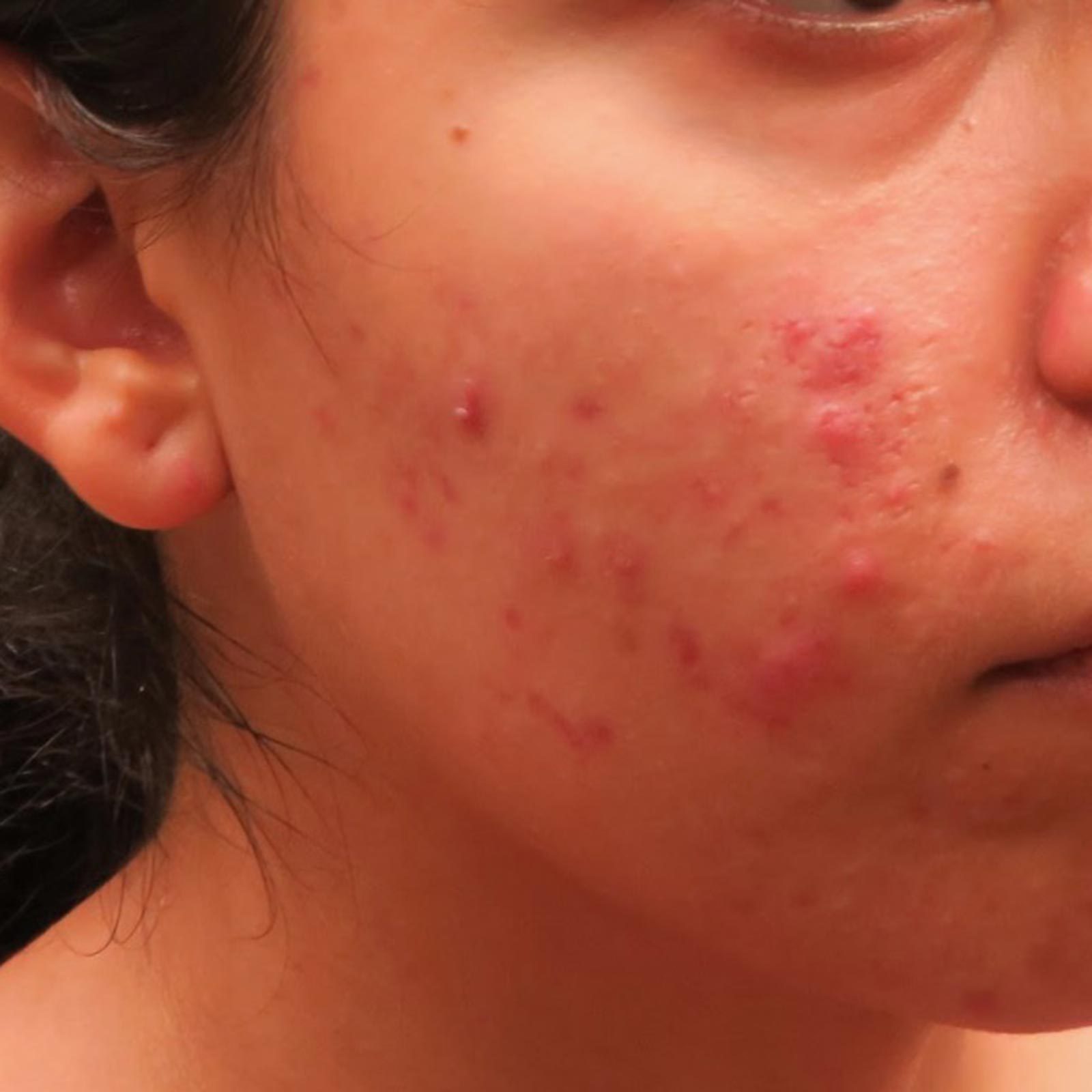 Dr. Pimple Popper Reveals the Acne You Shouldn't Pop | Reader's Digest