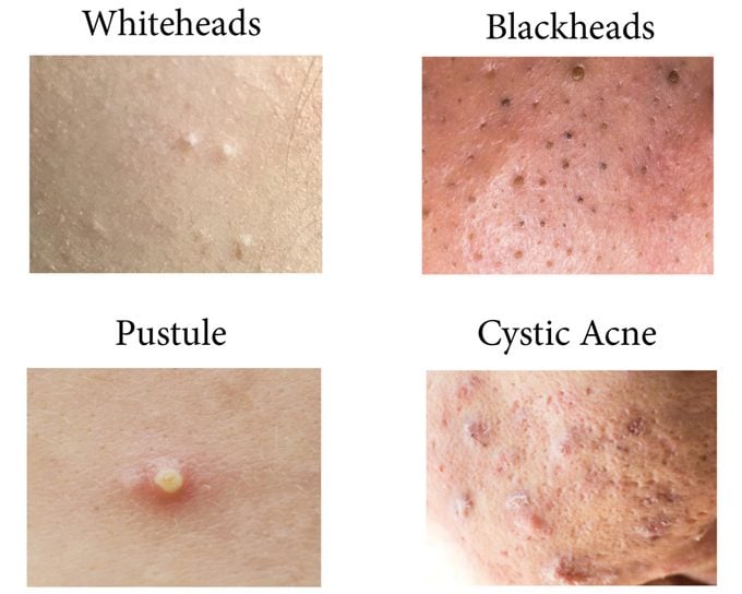Forbigående Persuasion Luske Dr. Pimple Popper Reveals the Acne You Shouldn't Pop | Reader's Digest