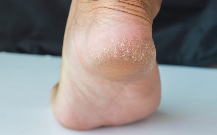 Closed-up of a dry and cracked heel