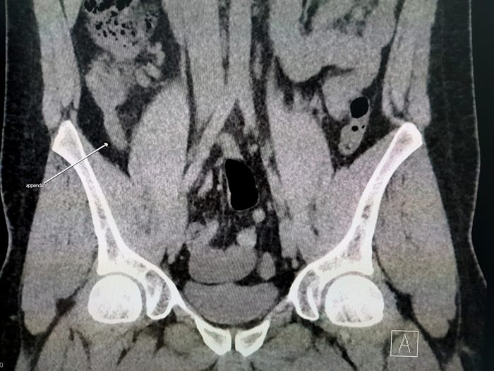 CT Scan of Abdomen showing Swollen Appendix - Coronal view