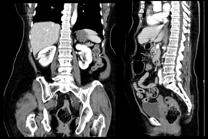 CT scan abdomen